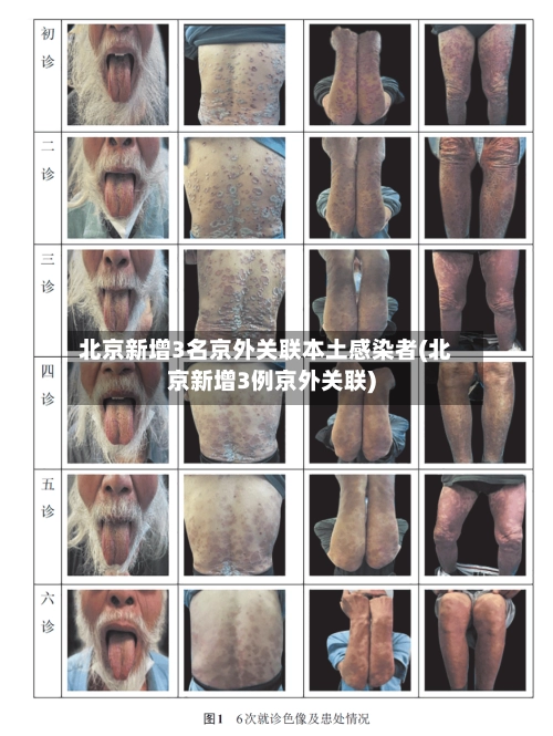 北京新增3名京外关联本土感染者(北京新增3例京外关联)-第2张图片